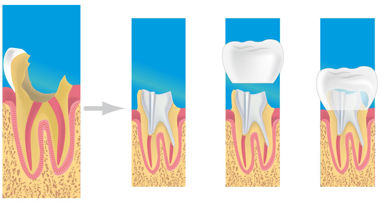 Le Centre dentaire Sarcelles-Garges les Gonesse à Sarcelles (95), vous présente les prothèses dentaires.