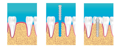 Implant dentaire Sarcelles