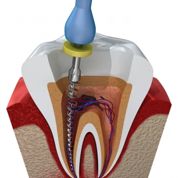 traitement endodontique