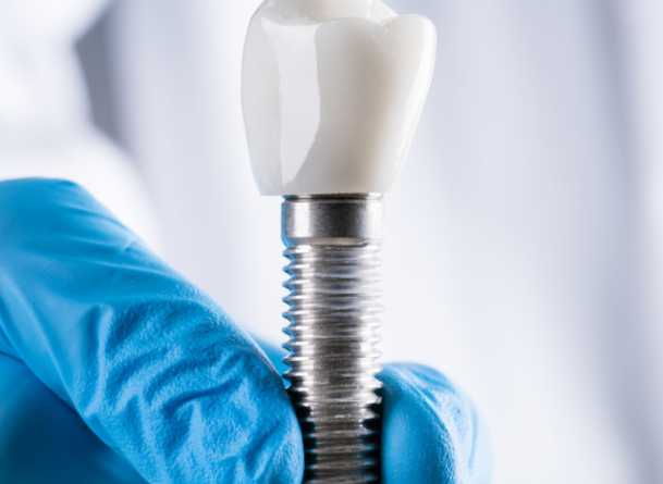 Les 5 questions les plus fr&eacute;quentes sur les implants dentaires